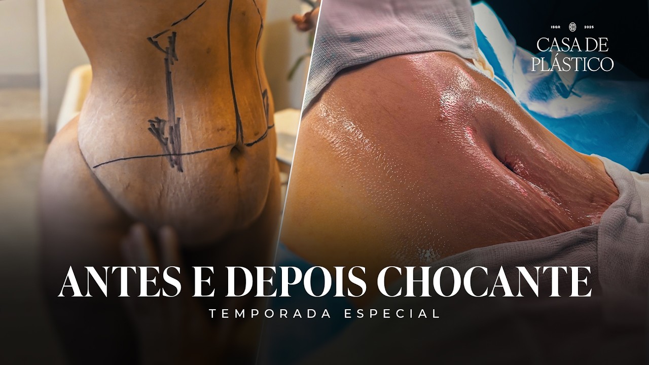 Casa de Plástico: Ela cruzou o mundo pra realizar o sonho!🌎 Lipo HD + Abdominoplastia | Dr. Ícaro