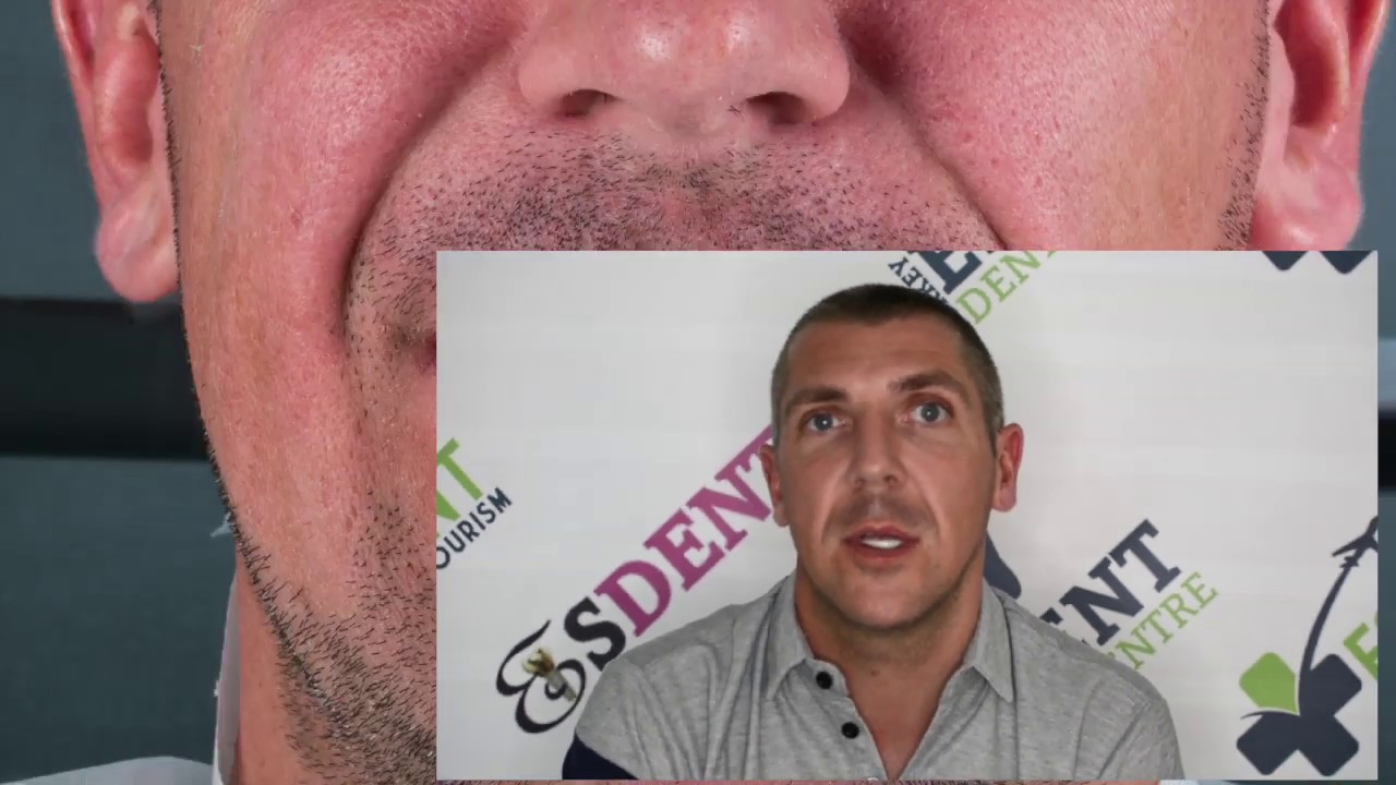 Patient Review - Dental Treatment (Crowns / Veneers) in Esdent Dental Centre Turkey