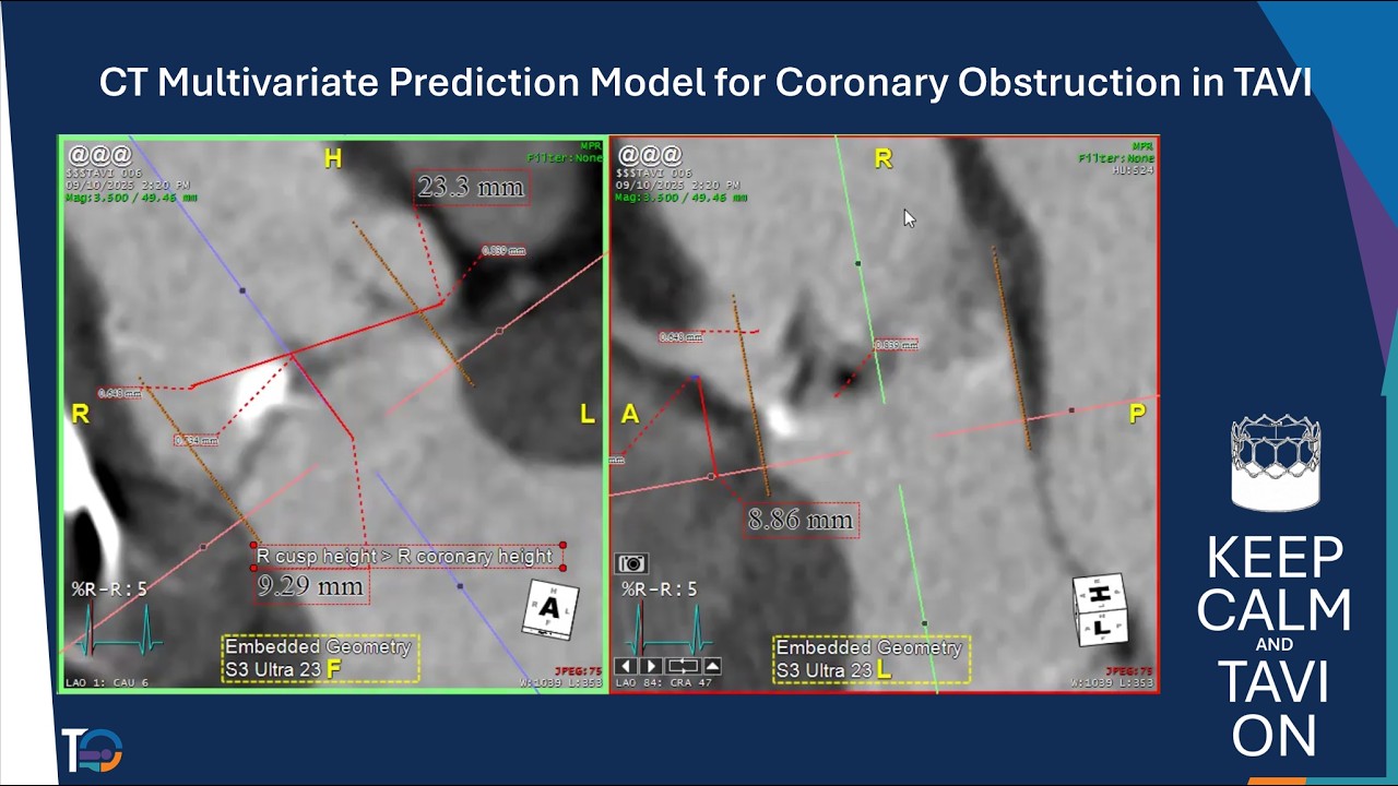 CT Multivariate Prediction Model for Coronary Obstruction in TAVI