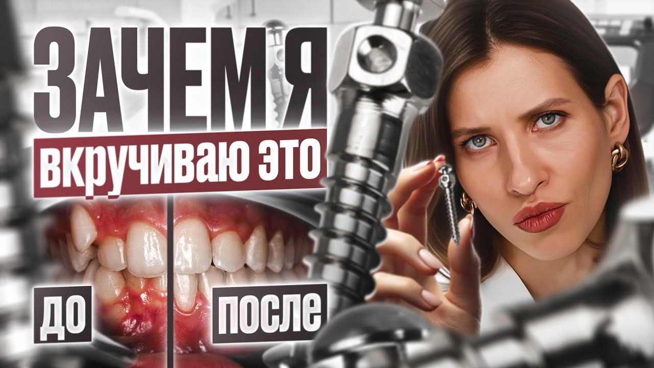 Как мини винты помогают выравнять прикус | Приходить ортодонтов или необходимость?