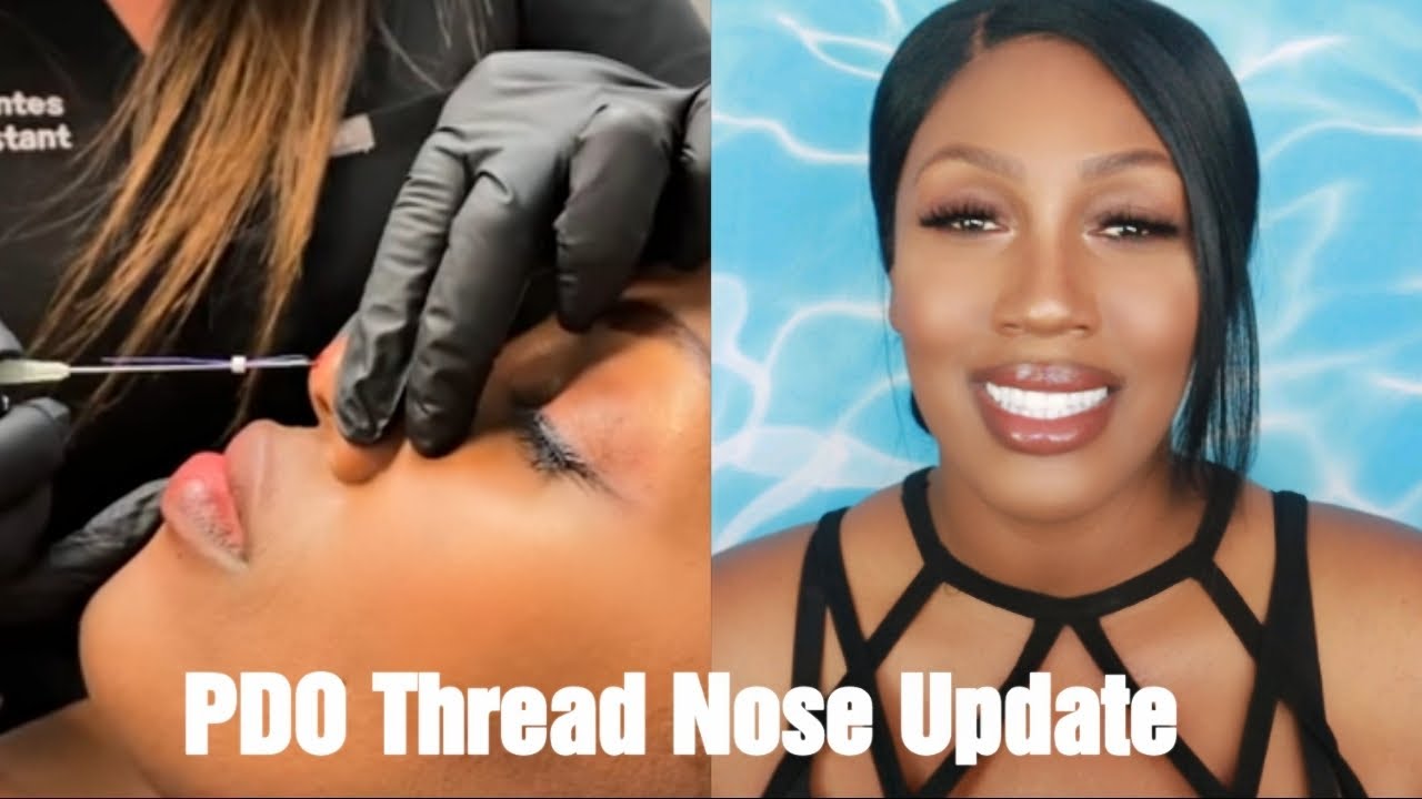 PdO Nose filler update