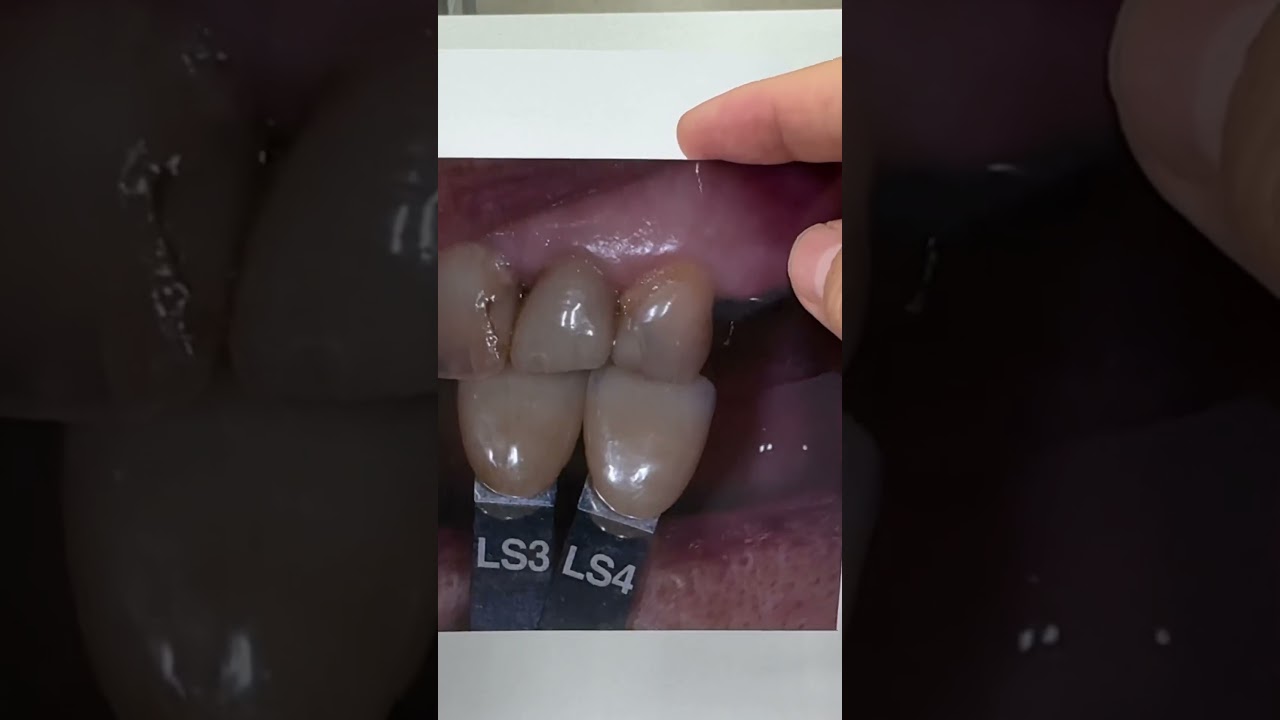 Perfect shade guide for implant bridge! @EnvisiontecMain #envisiontec