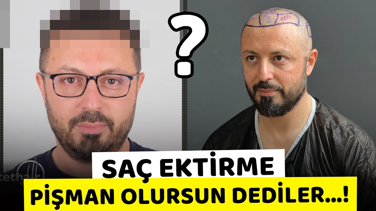 SAÇ EKTİRDİM | 1 YIL İÇİNDE NELER YAŞADIM | SONUÇ NE OLDU?