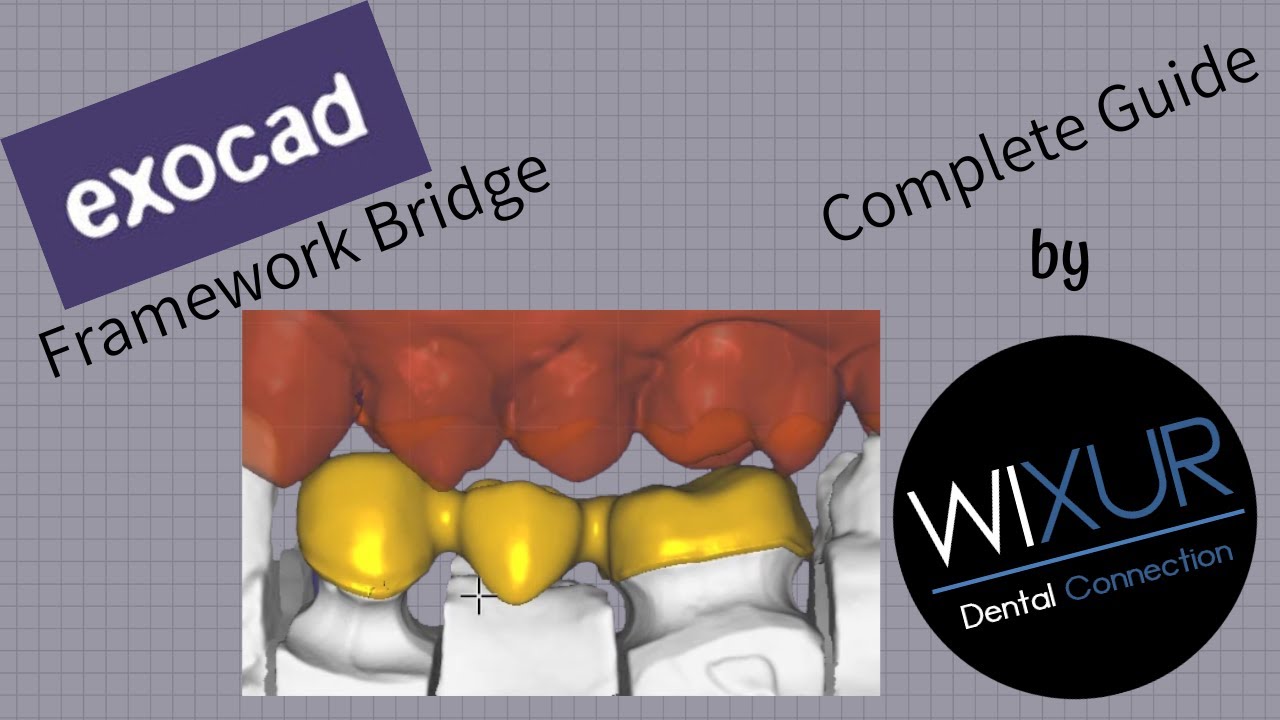 How to design a Framework Bridge with Exocad