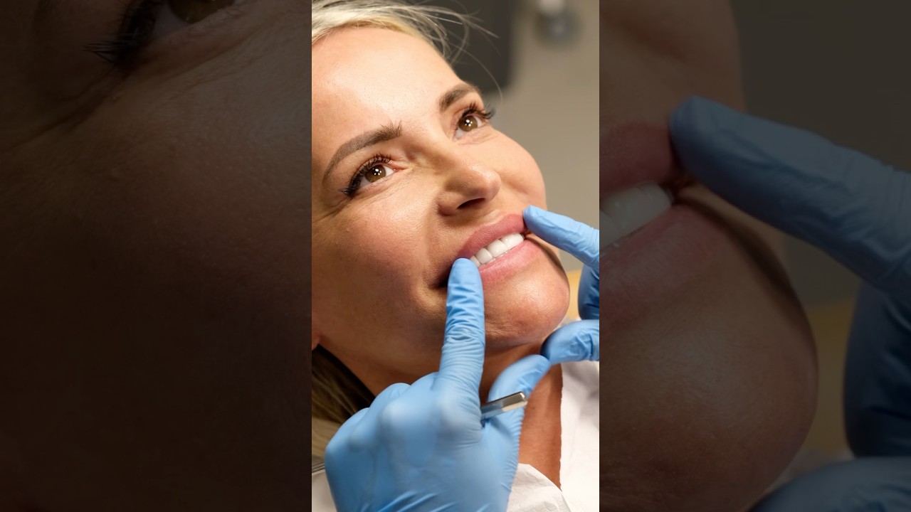 Zirconia Crowns from Antlara 🌟🦷 #dentalclinic #zirconiacrowns #smile