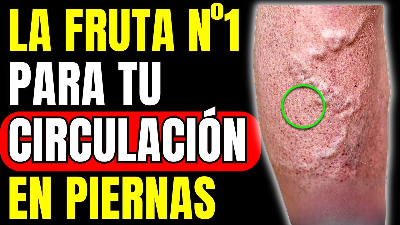 VARICES e INSUFICIENCIA VENOSA: La FRUTA ECONÓMICA #1 (CÓMO TOMARLA)