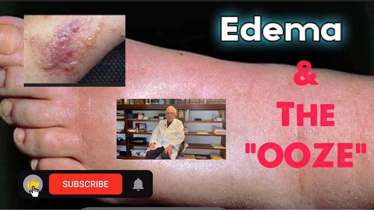 Eczema: Ooze and Edema Explained.  Topical Steroid Withdrawal - Dr. Rapaport