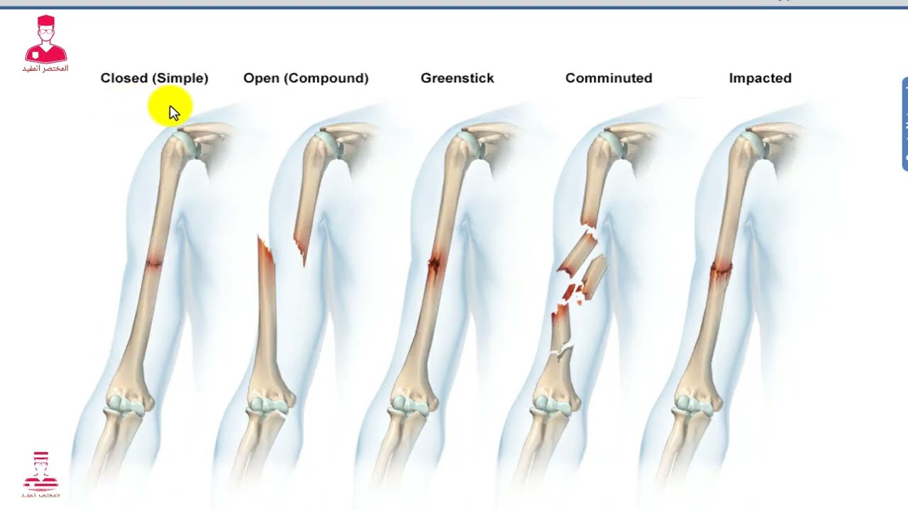 أنواع الكسور وكيف يلتئم العظام || TYPES OF FRACTURES