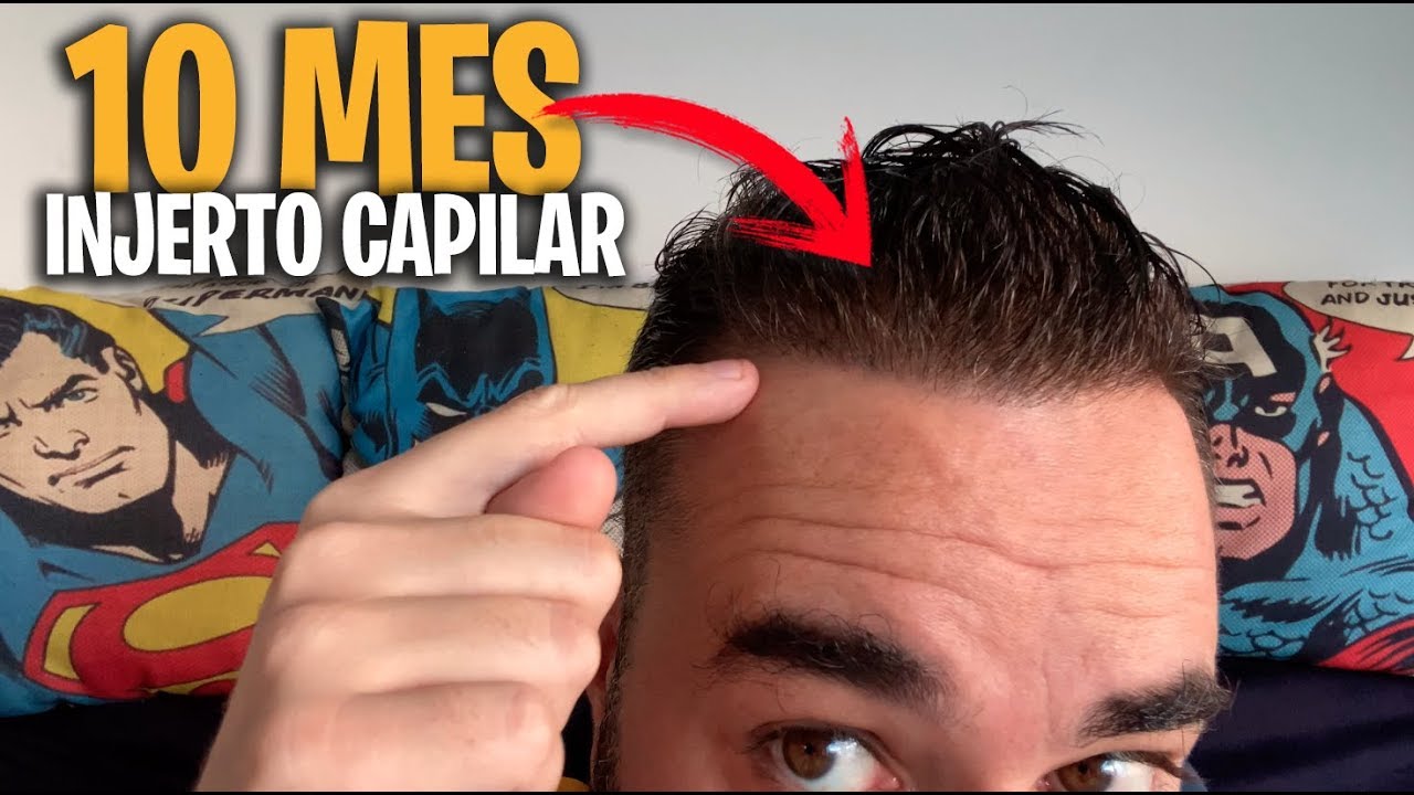 injerto capilar 10 mes de evolución Técnica FUE SIN RAPAR