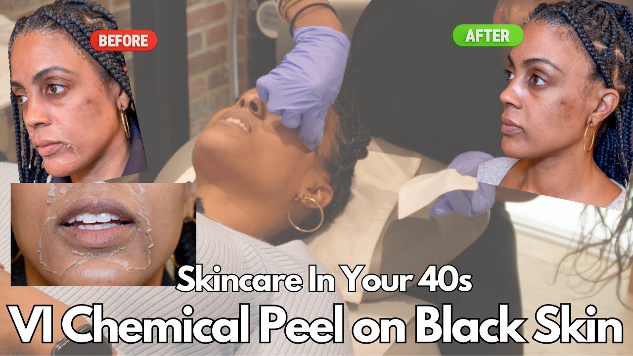 How To Treat Hyperpigmentation and Dark Spots on Black Skin Using A VI Precision Plus Chemical Peel