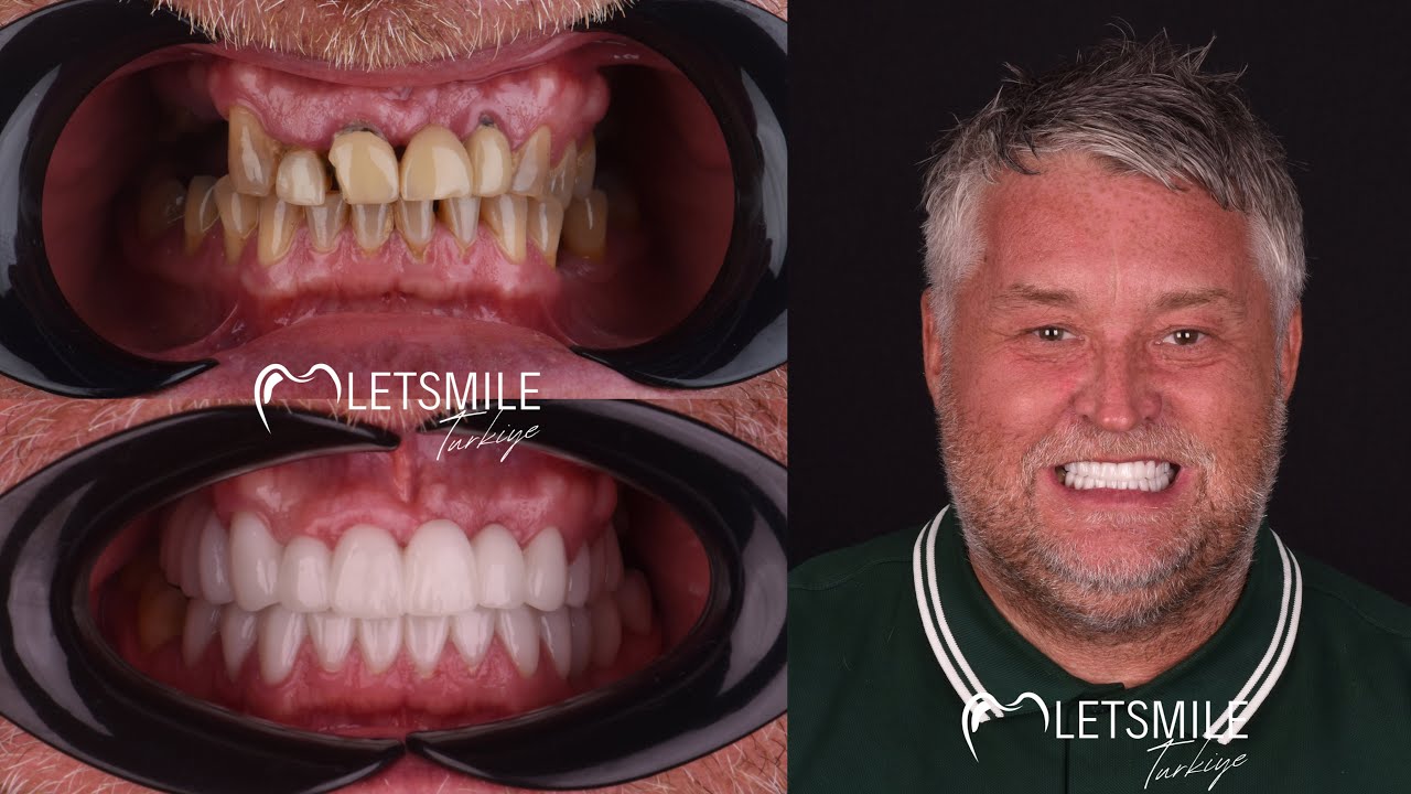 Dental Centre Antalya / Turkey  LETSMILE TURKIYE Best Smile Makeover | Turkey Dental Clinic