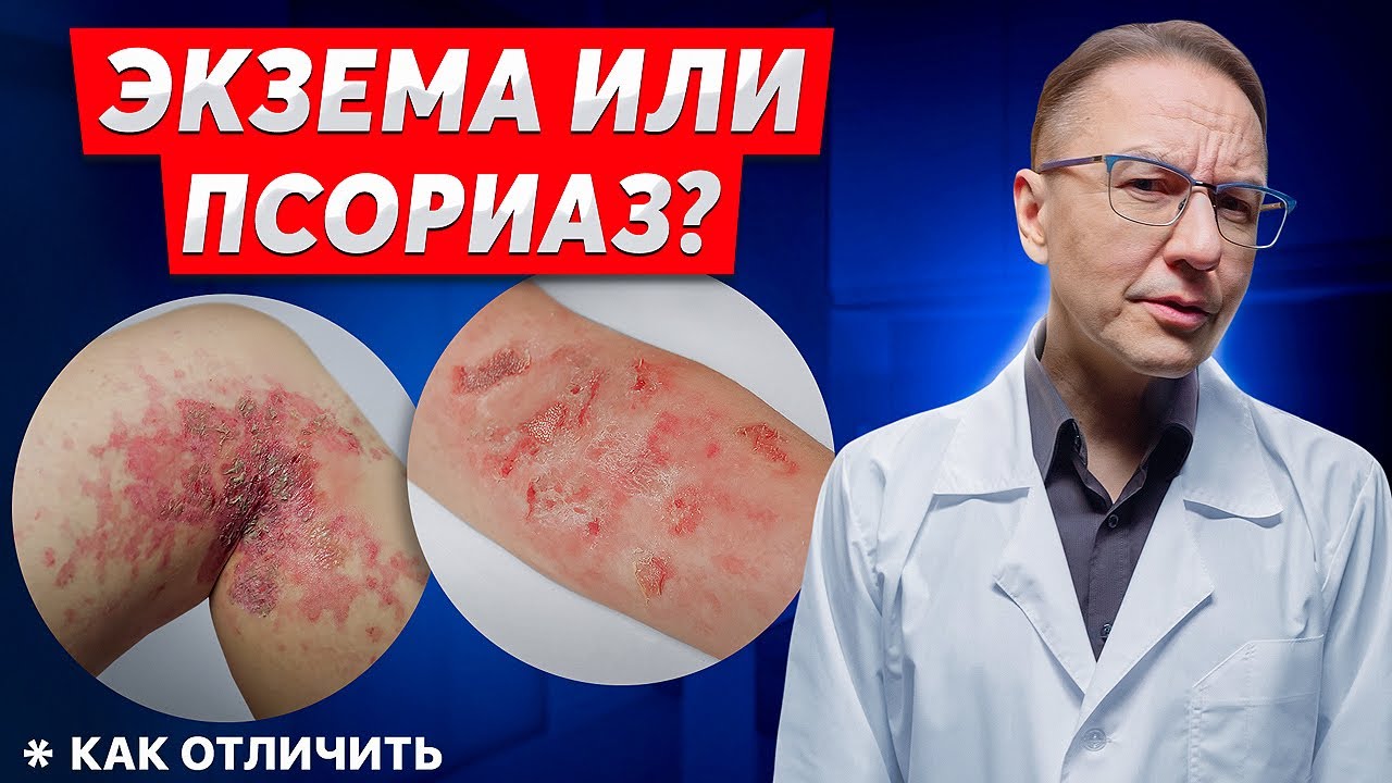 Как отличить экзему и псориаз? Полный гайд