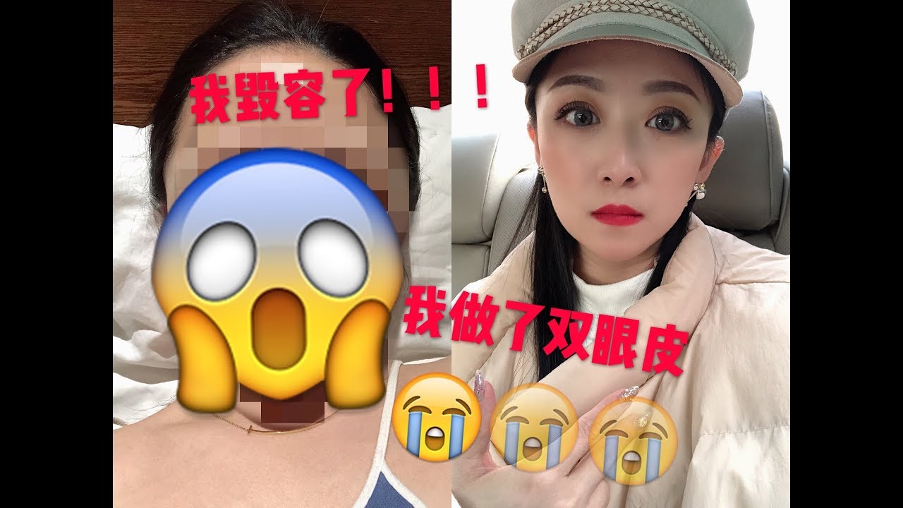 我毁容了/我做了日式无痕双眼皮