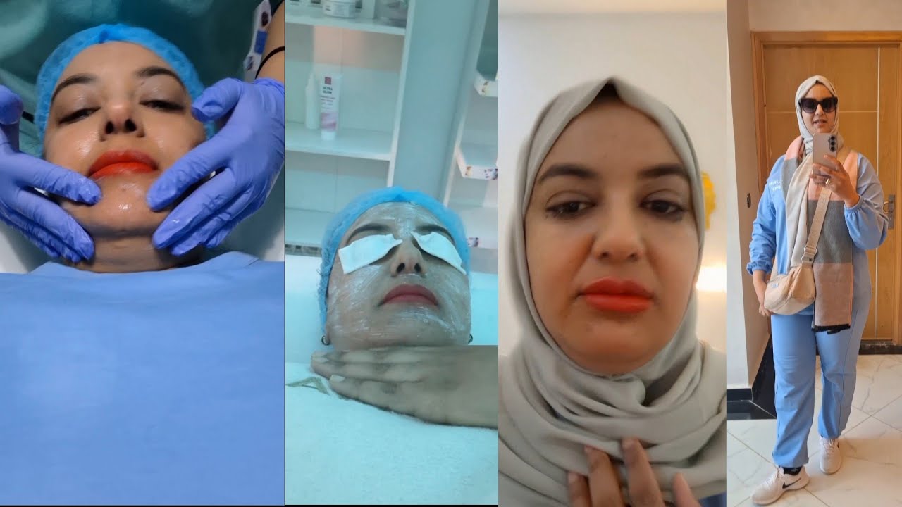 مشيت ندير التجميل شفو كفاش رجع وجهي وشفايفي أول مرة ندير التجميل 