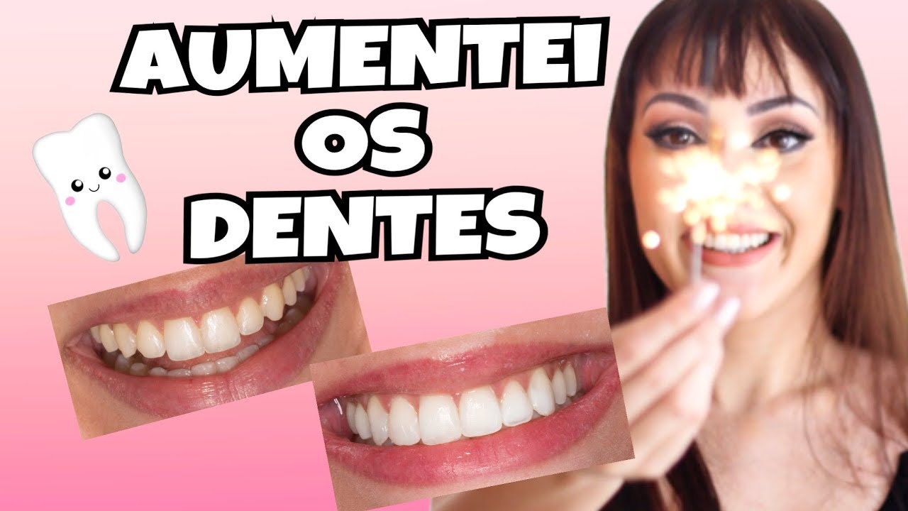MINHA EXPERIÊNCIA COM AUMENTO DE RESINA NOS DENTES!