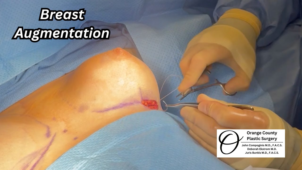 Breast Augmentation | Orange County Plastic Surgery