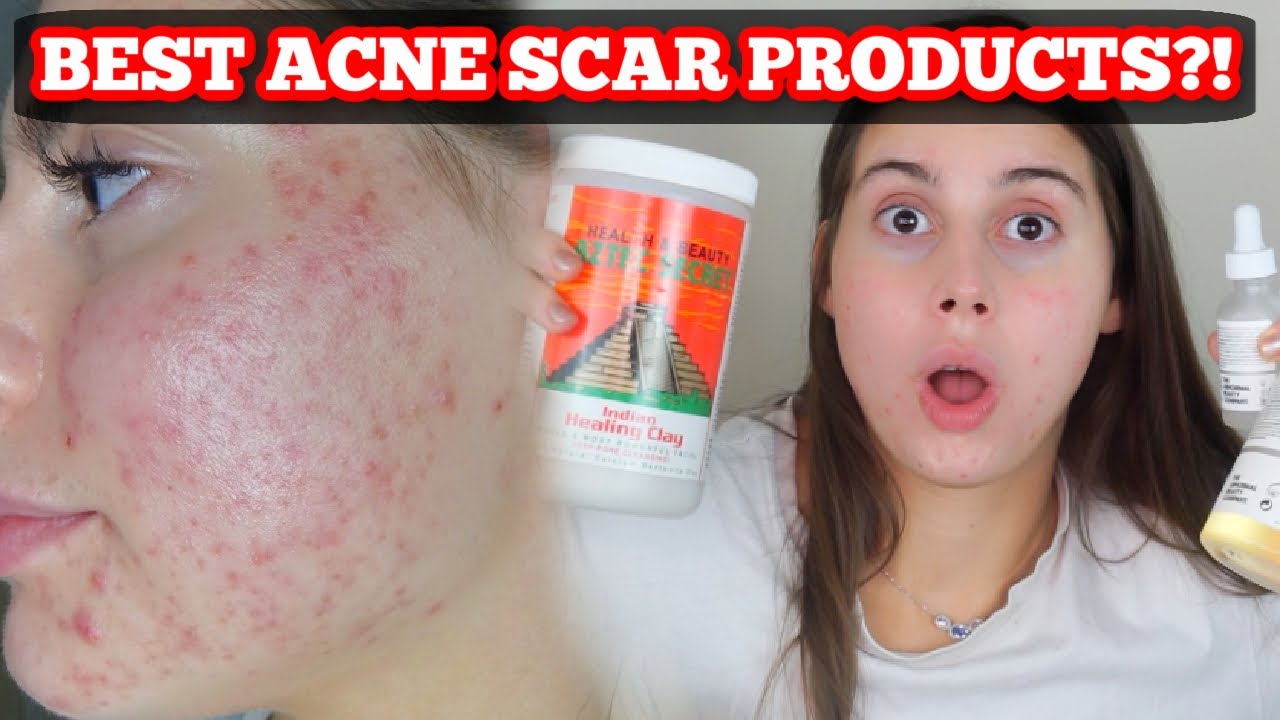 BEST PRODUCTS FOR ACNE SCARS AND SKIN HEALING!!