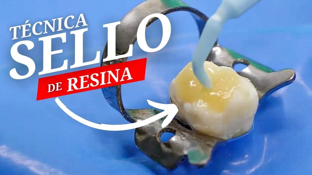 Tecnica de Sello para resina Dental