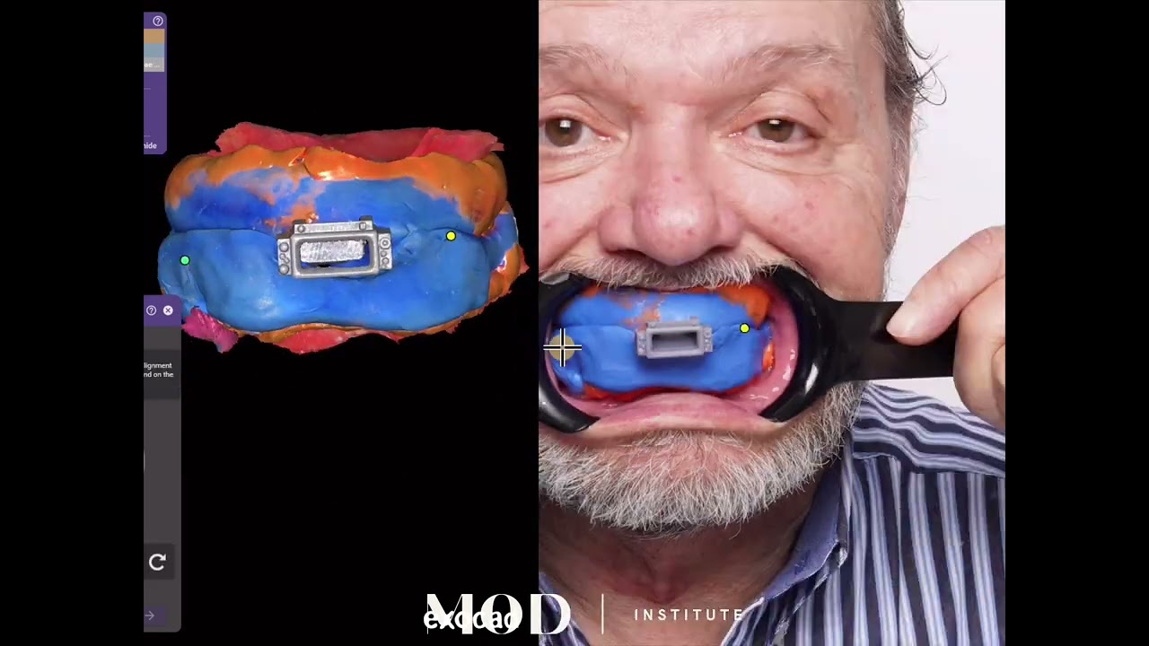 Same Day 3D printed dentures