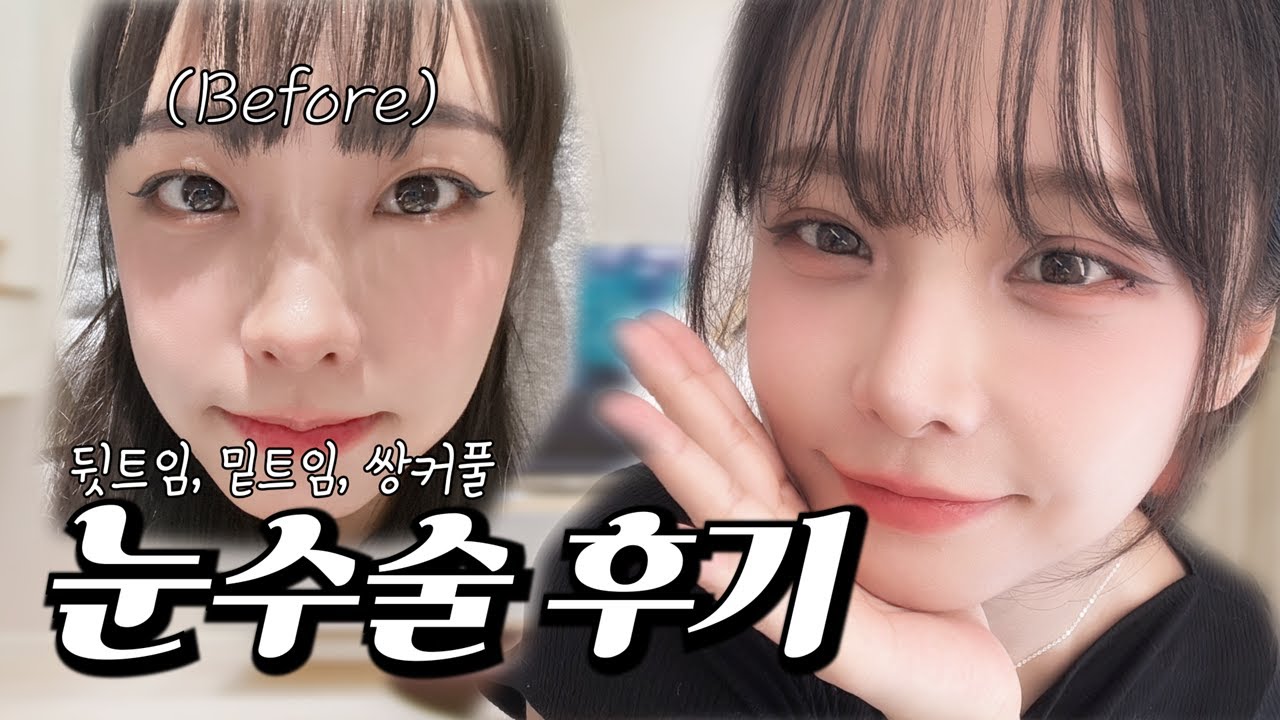 눈 성형(상담 팁, 수술 과정, 병원 힌트 등) 후기
