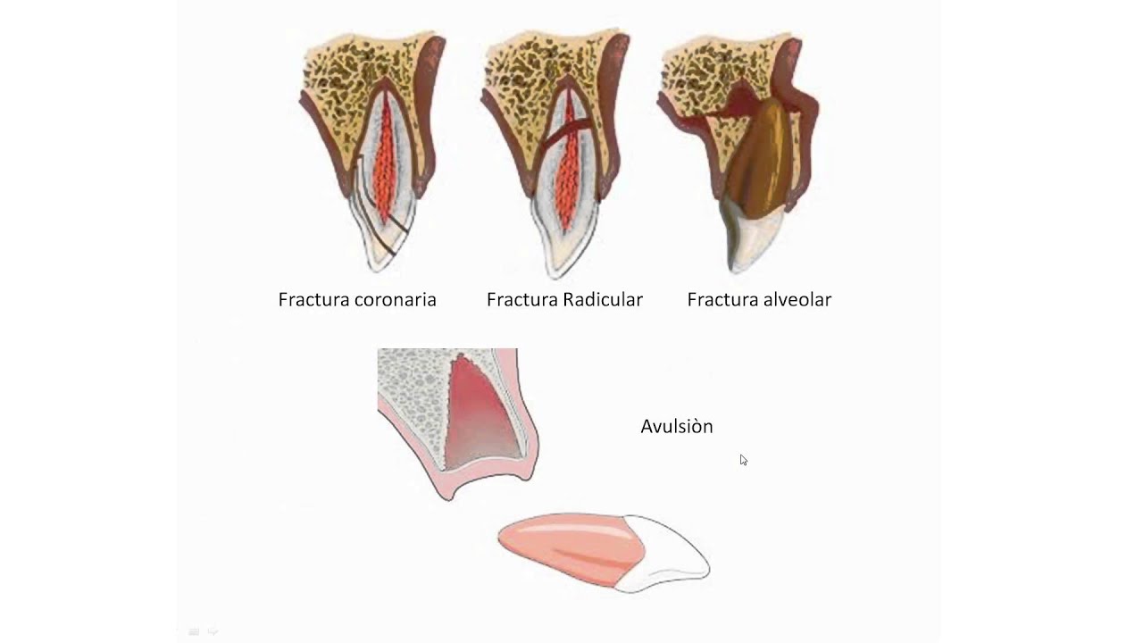 Traumatismos Dento-Alveolares