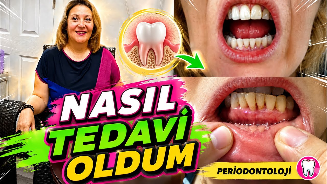 DİŞ ETİ RAHATSIZLIĞIM / GİNGİVİTİS NEDİR? / PERİODONTOLOJİ NEDİR? / NASIL TEDAVİ OLDUM