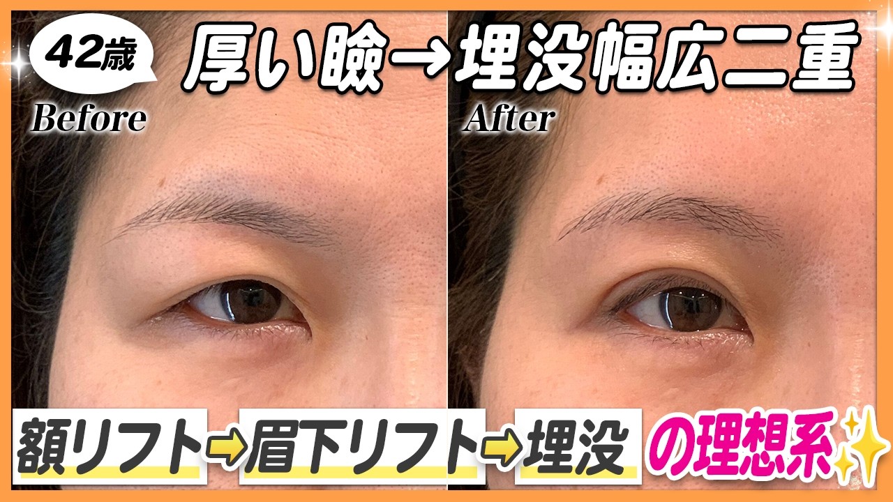 【44歳 額・目周り整形】額リフト、眉下切開、埋没法を行なって、大きな変化を感じて頂いた症例がこちらです💁‍♀️✨