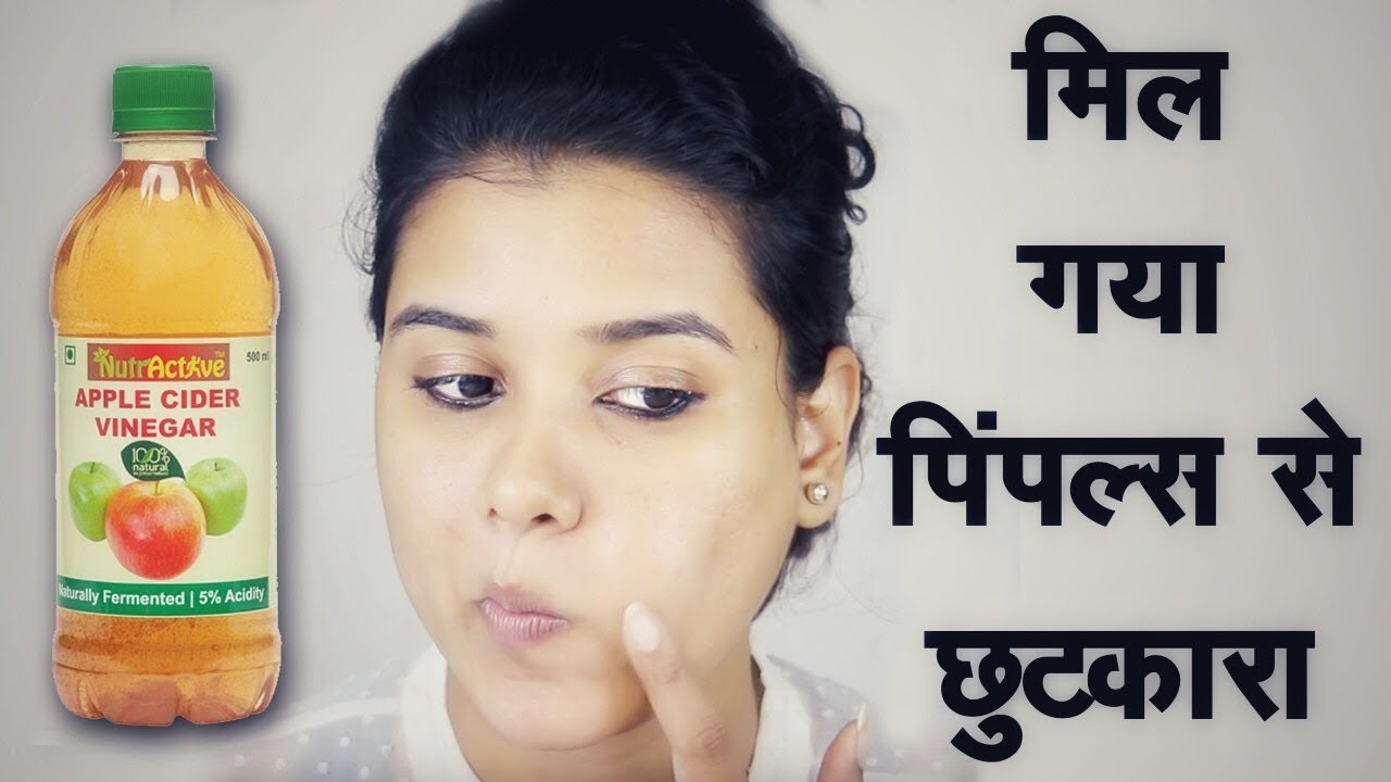 Skin Care for Acne Prone Skin (Hindi)