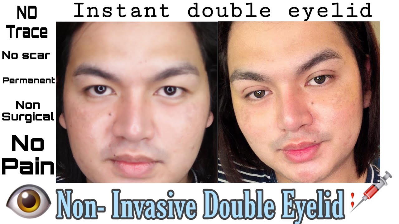 Non- Invasive Double Eyelid Procedure | No Surgery No Scar  | Bryan Bartolay