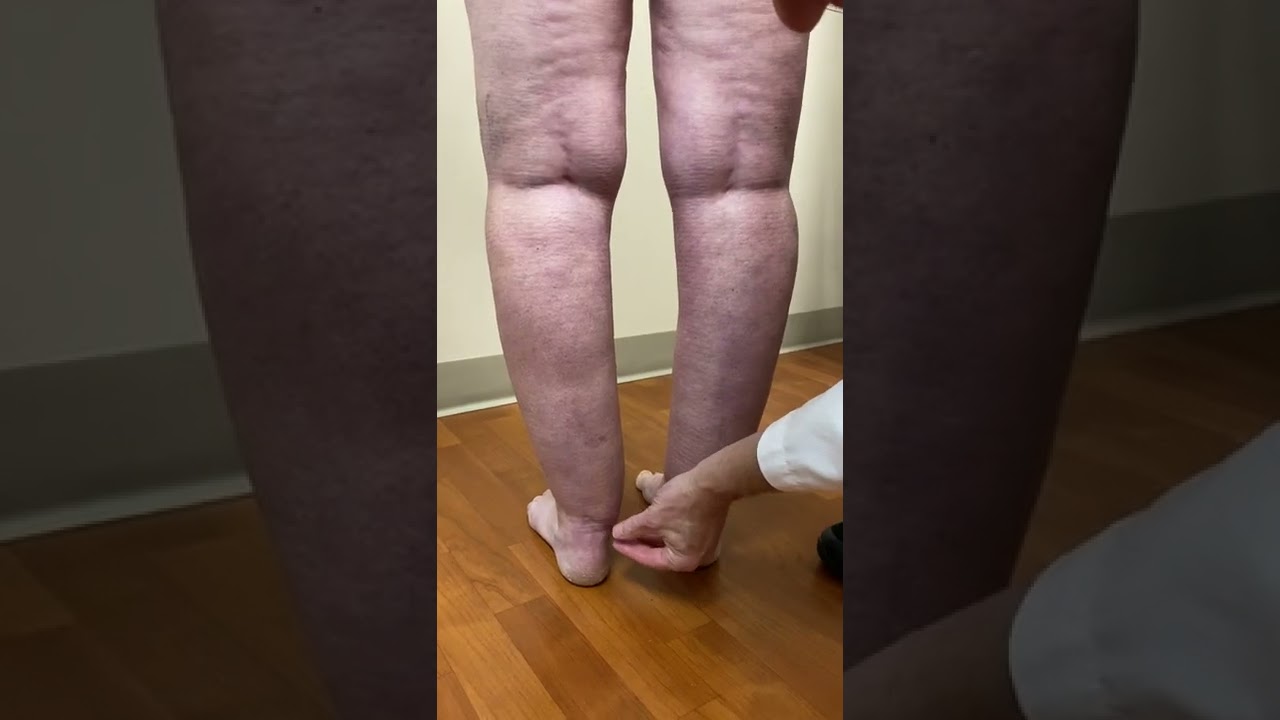 Dr. Wright demonstrates physical signs of lipedema