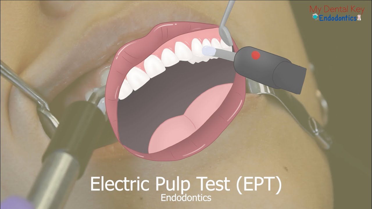 Electric Pulp Testing | My Dental Key