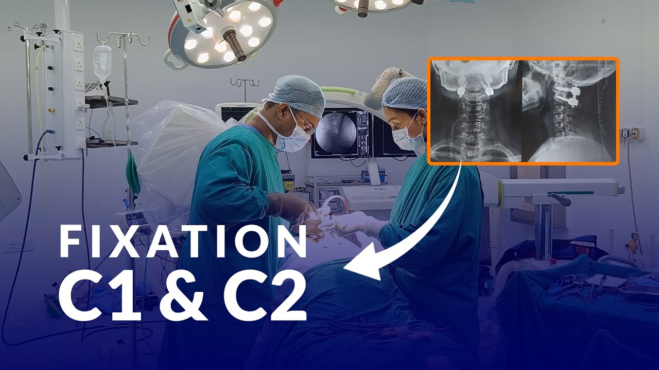 Atlantoaxial Dislocation: A Case Study of Successful C1-C2 Fixation | Dr. Surendra Gupta