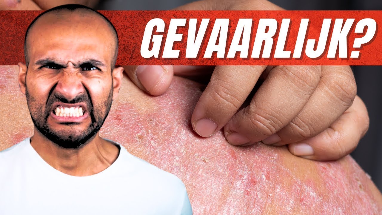 Jeuk Bij Diabetes Type 2? Oorzaken + 5 Nuttige Tips