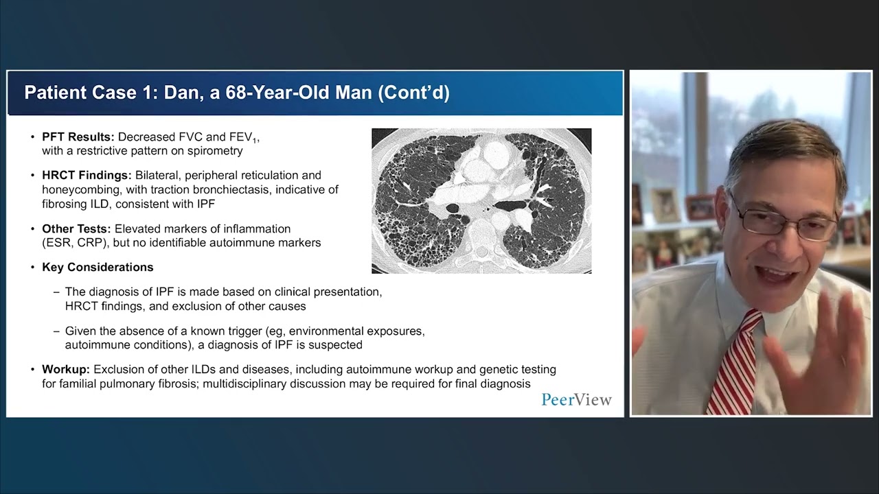 Pulmonary Fibrosis: Fine-Tuning Diagnosis and Illuminating Novel Pathways for Emerging Treatments