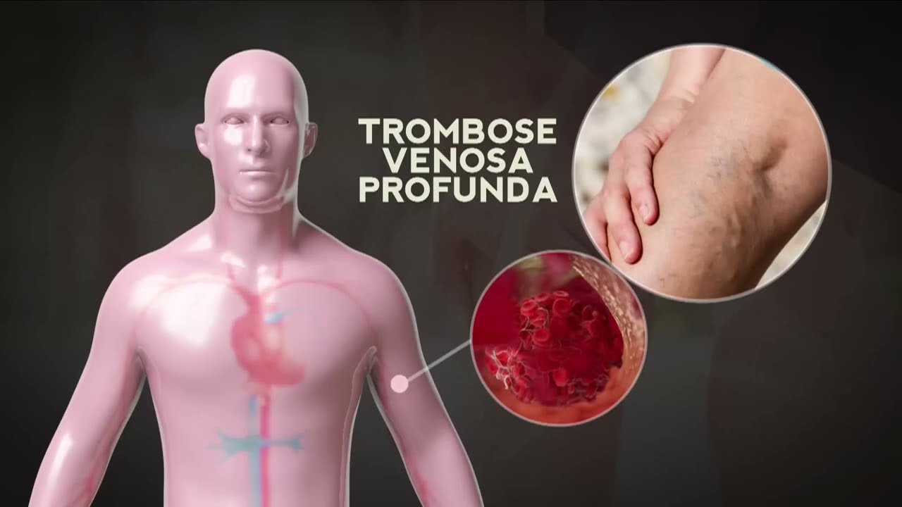 Tudo o que você precisa saber sobre trombofilia