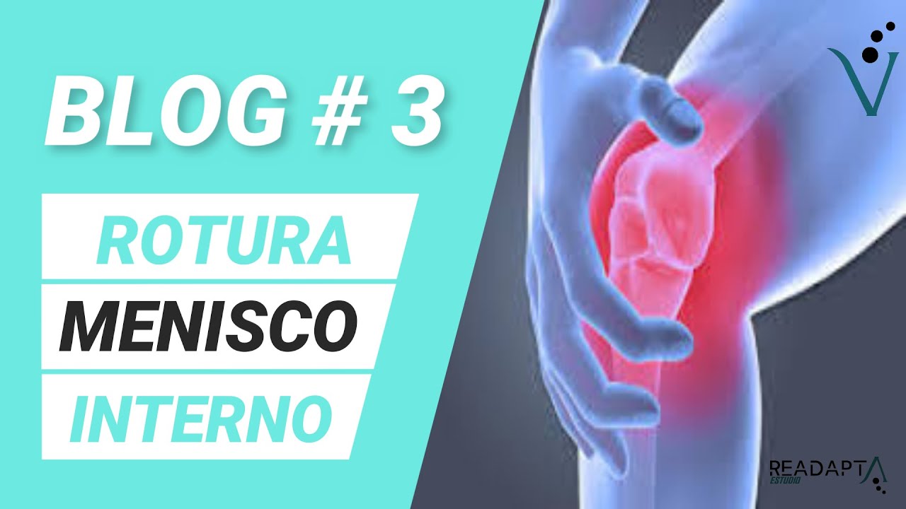 ROTURA DE MENISCO INTERNO &iquest;ME OPERO O NO ME OPERO?