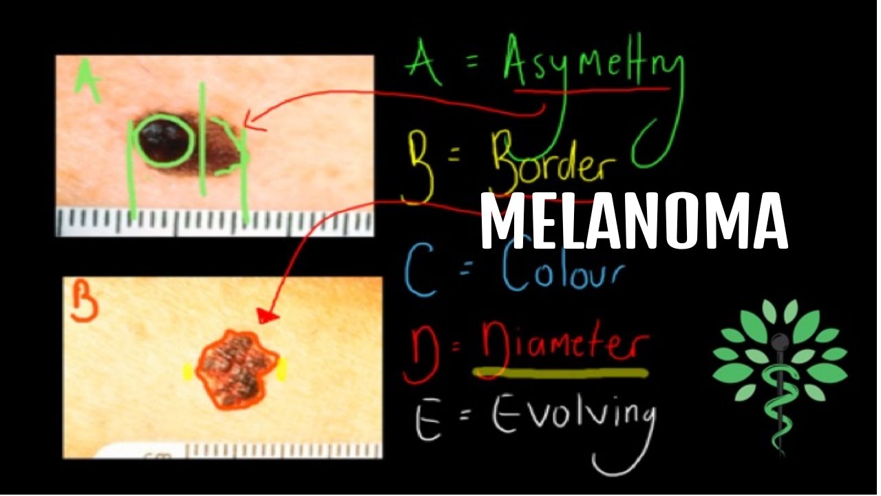 Melanoma - Symptoms, signs, diagnosis and management
