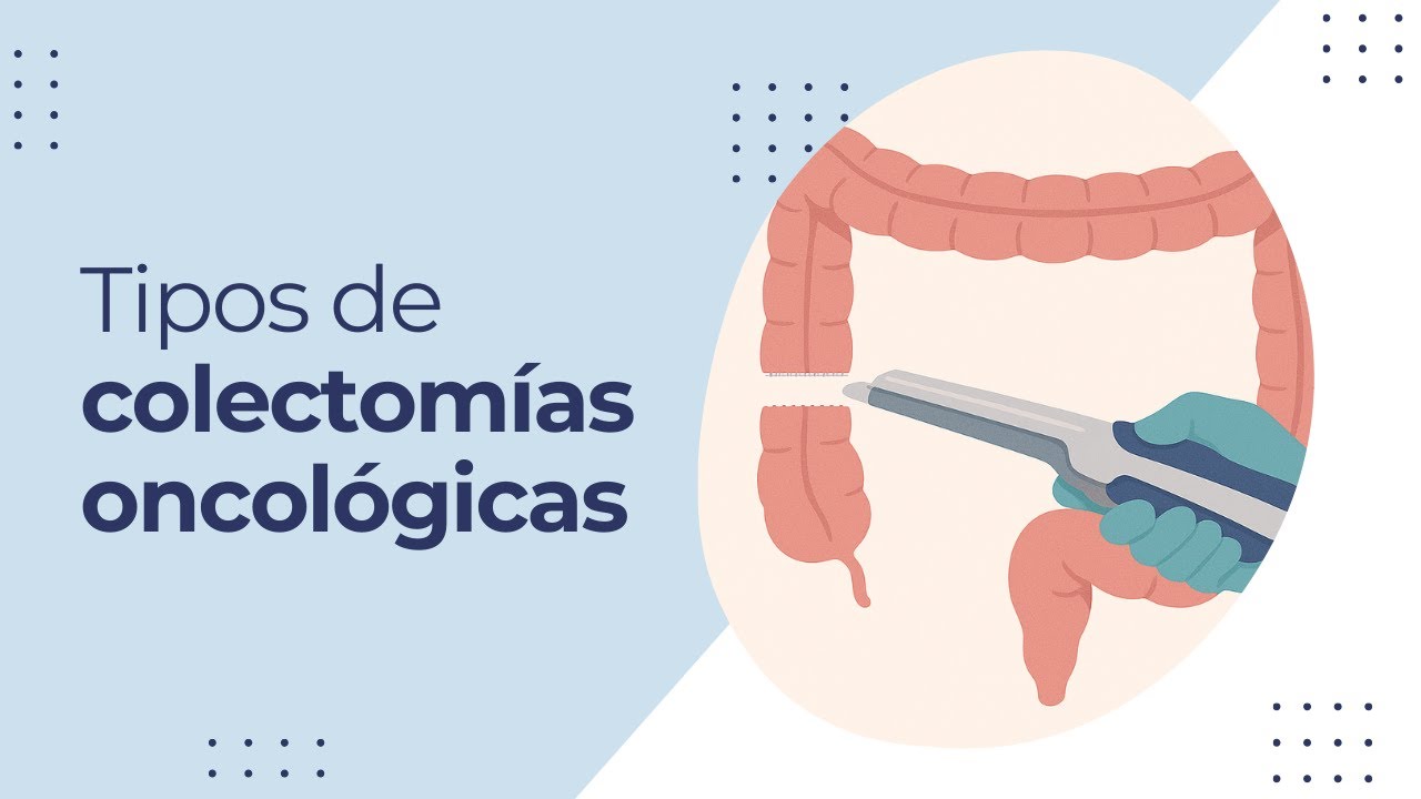 Tipos de Colectomías Oncológicas: Extensión de la Resección y Ligaduras Vasculares