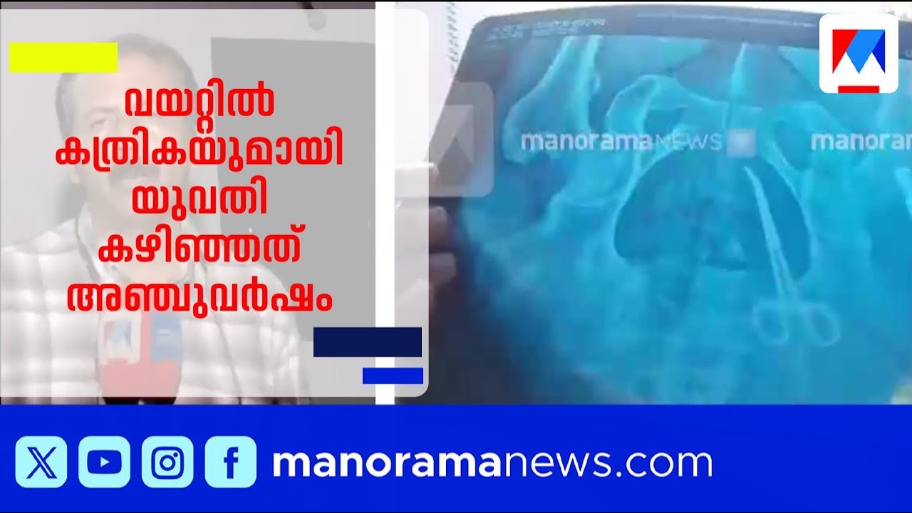 വയറ്റിൽ കത്രികയുമായി യുവതി കഴിഞ്ഞത് അഞ്ചുവർഷം;ആലപ്പുഴ മെഡിക്കൽ കോളേജിനെതിരെ പരാതി|Medical negligence