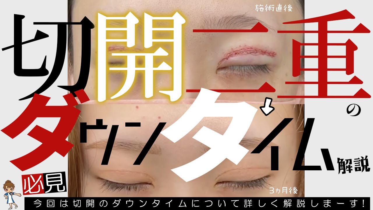 【必見】切開二重のダウンタイムについて詳しく話します。