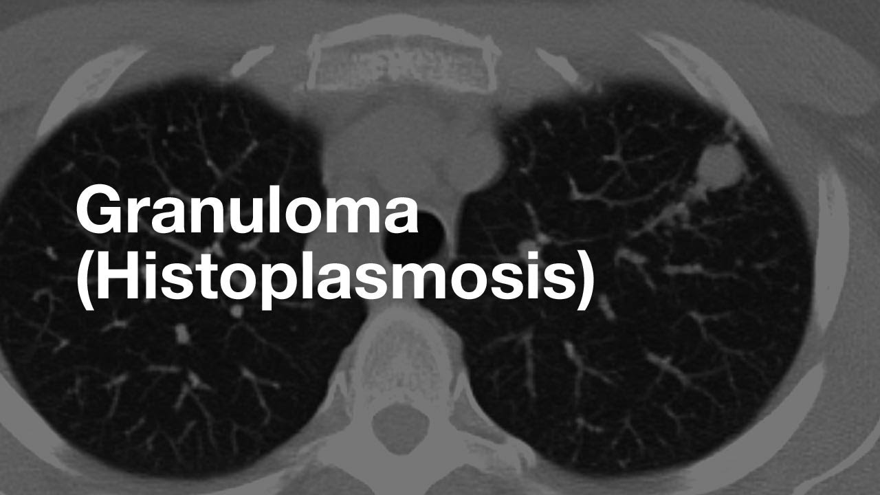 Classic Case: Granuloma from Histoplasmosis