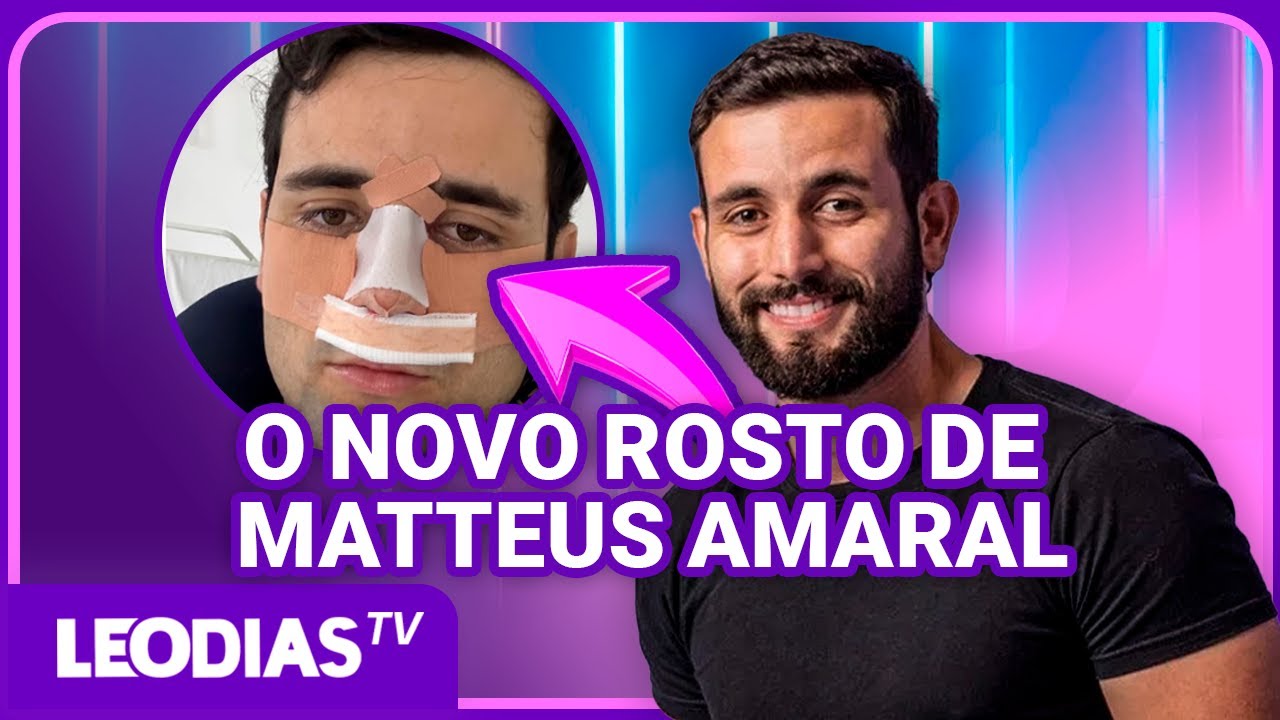 EX-BBB MATTEUS AMARAL FAZ PLÁSTICA NO NARIZ E MOSTRA O RESULTADO