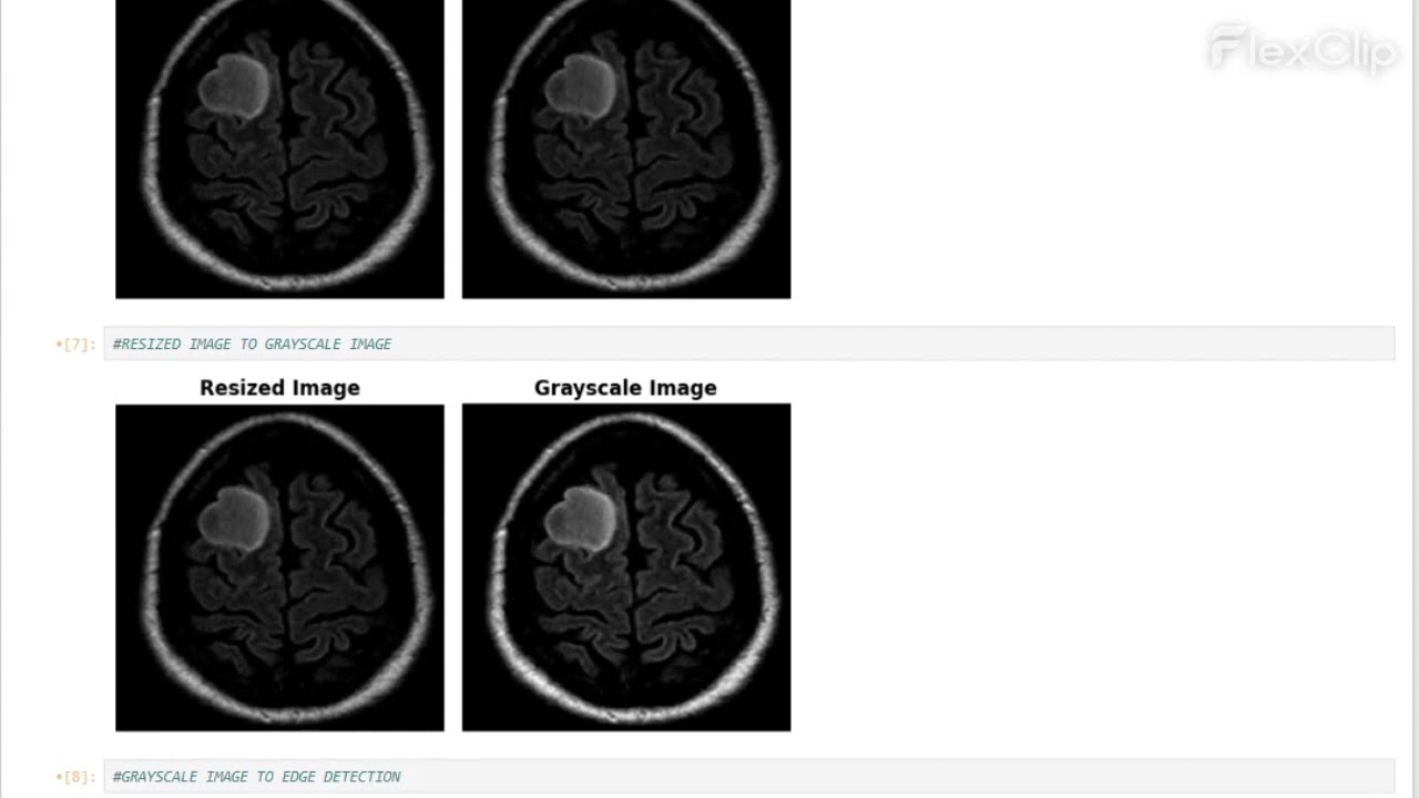 ARCHITECTURE OF A RESNET BASED DEEP LEARNING MODEL FOR MULTI CLASS BRAIN TUMOUR CLASSIFICATION