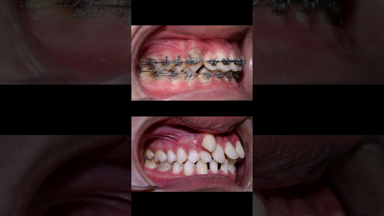 Braces are very crooked #braces #orthodontist #dentist #dental #dentistry