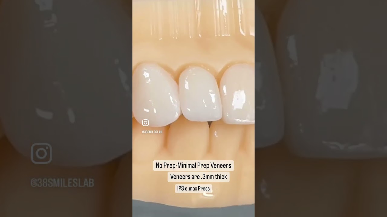 A Conservative approach while reducing as little as possible really can yield awesome esthetics! 🦷