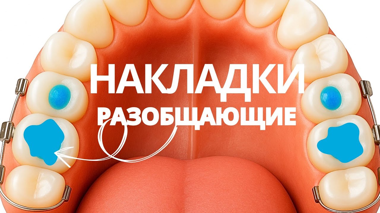 НАКЛАДКИ с брекетами | Самое страшное в ортодонтии
