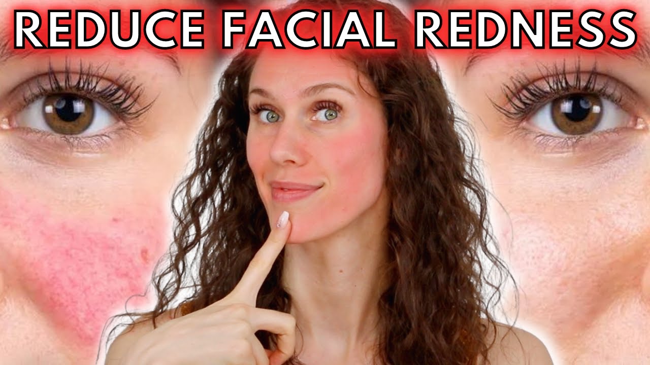 🔴 5 Reasons Your Face Is Always Red (Rosacea to Dermatographia & Everything In-between!)