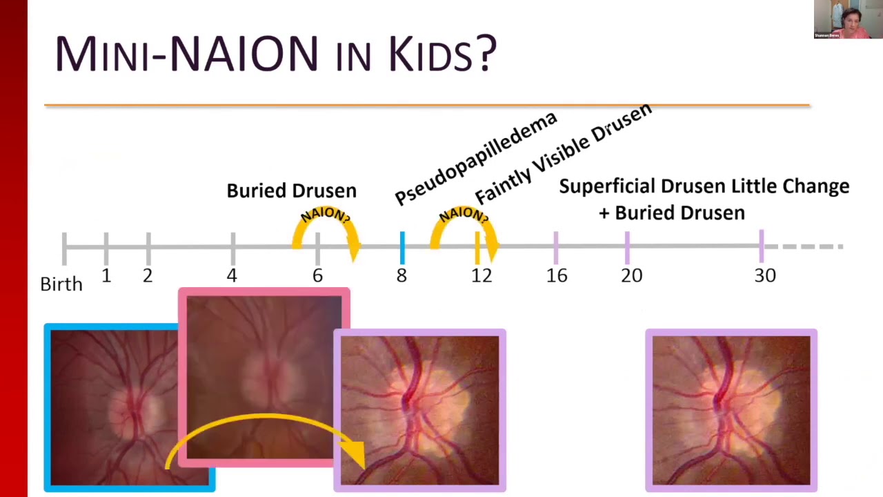 Ophthalmic imaging and biomarkers of optic neuropathies in children