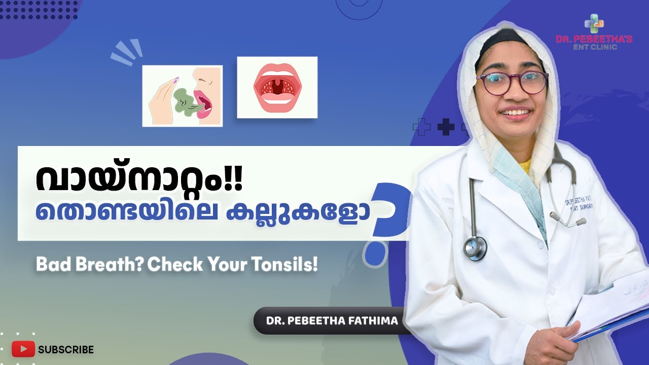 തൊണ്ടയിലെ കല്ലുകൾ: ലക്ഷണങ്ങളും ചികിത്സയും. Tonsil Stones : Symptoms and Treatment Explained.