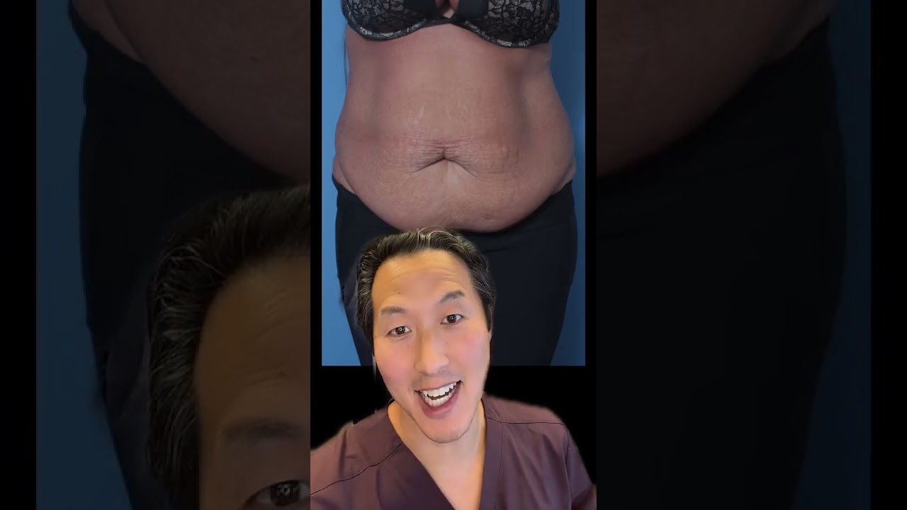 Great Tummy Tuck Results by Dr. Youn! #tummytucksurgery #tummytuckbeforeandafter #confidence #happy